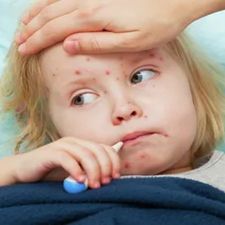 çocuklarda-kızamık-3